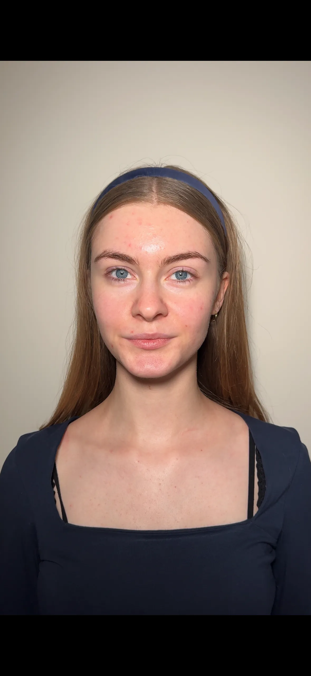 Cera trądzikowa problematyczna przed makijażem Gdańsk